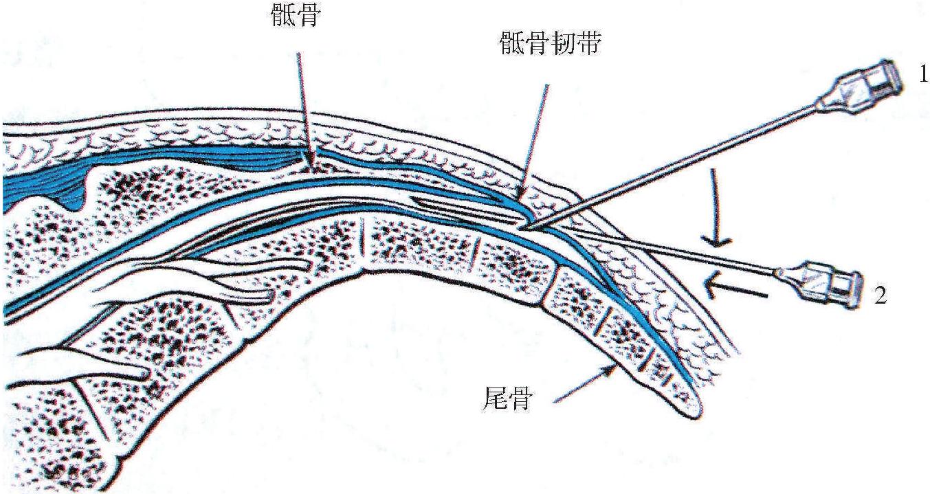 第二節(jié) 骶管注射術(shù)